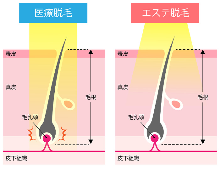 図解：医療脱毛、エステ脱毛
