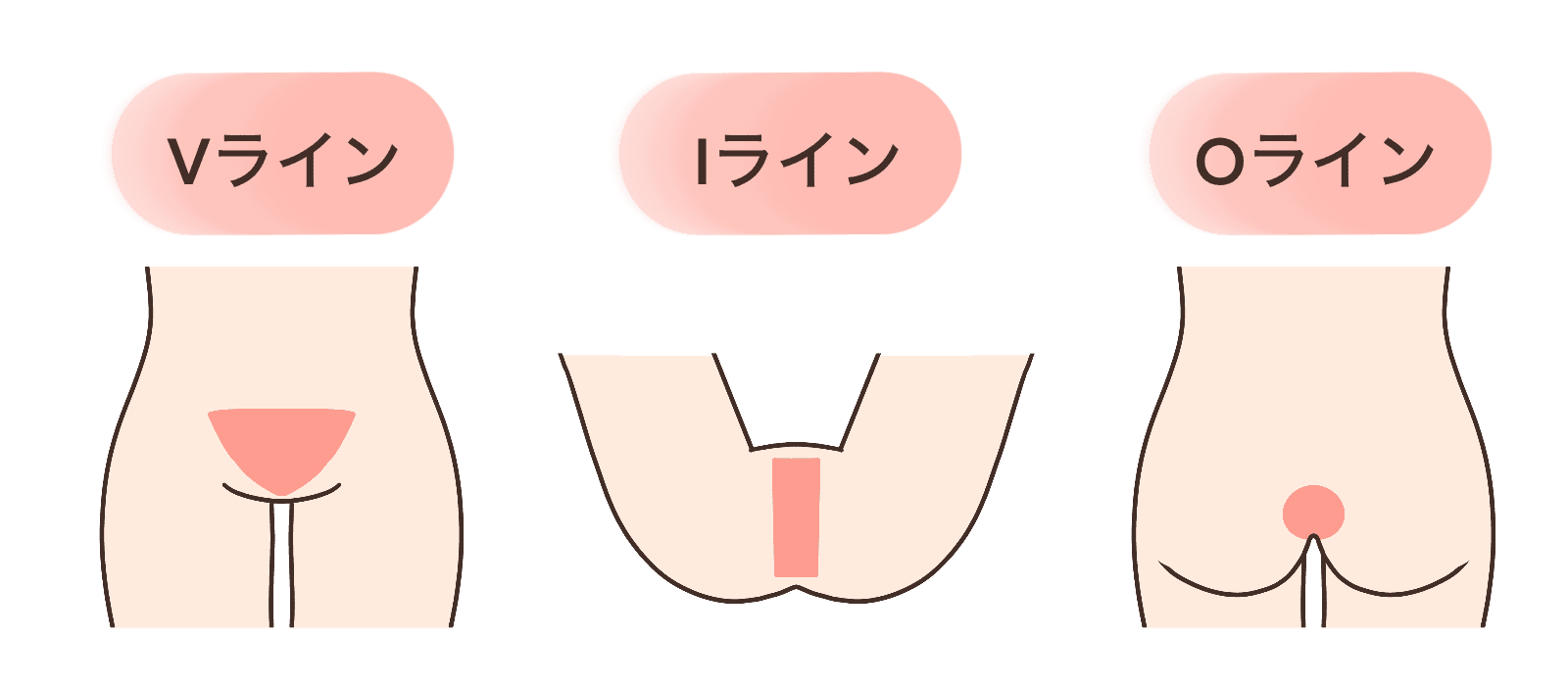 VIO脱毛の照射範囲（Vライン・Iライン・Oライン）